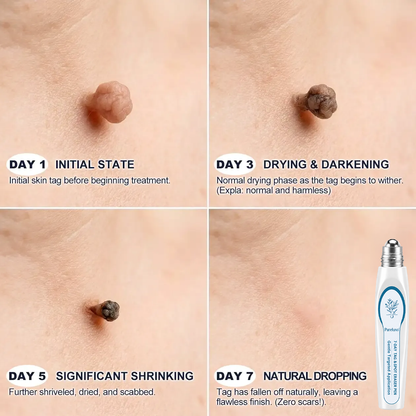 JOUS®🛍️ 𝟕-𝐃𝒂𝘆 𝐒𝗸𝐢𝐧 𝐓𝒂𝗴 & 𝐒𝐩𝙤𝐭 𝐄𝐫𝒂𝐬𝙚𝐫 Painless & Scar-Free Advanced Imperfection Removal Rollerball Pen